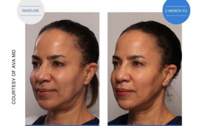 Dr. Yael Halaas and Dr. Michelle Aszterbaum Share the Perfect Gift this Holiday, SOFWAVE™ the newest non-invasive skin lifting treatment that’s creating a buzz